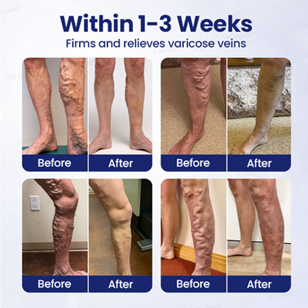 Varicose Veins Herbal Spray - MicroMist Therapy