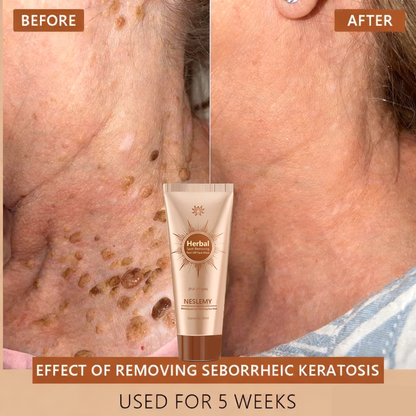 Mascarilla facial blanqueadora y eliminadora de manchas Adecuada para rostro y cuerpo – 👩‍⚕️ Los ingredientes naturales eliminan de forma permanente las manchas de la edad, las pecas, las manchas solares y las manchas hepáticas.